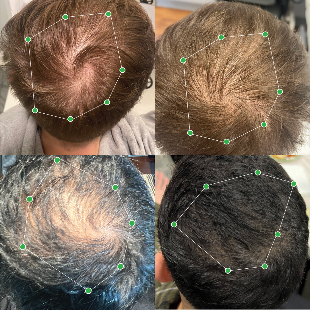 Four close-up images of scalps with polygonal markers on hair.