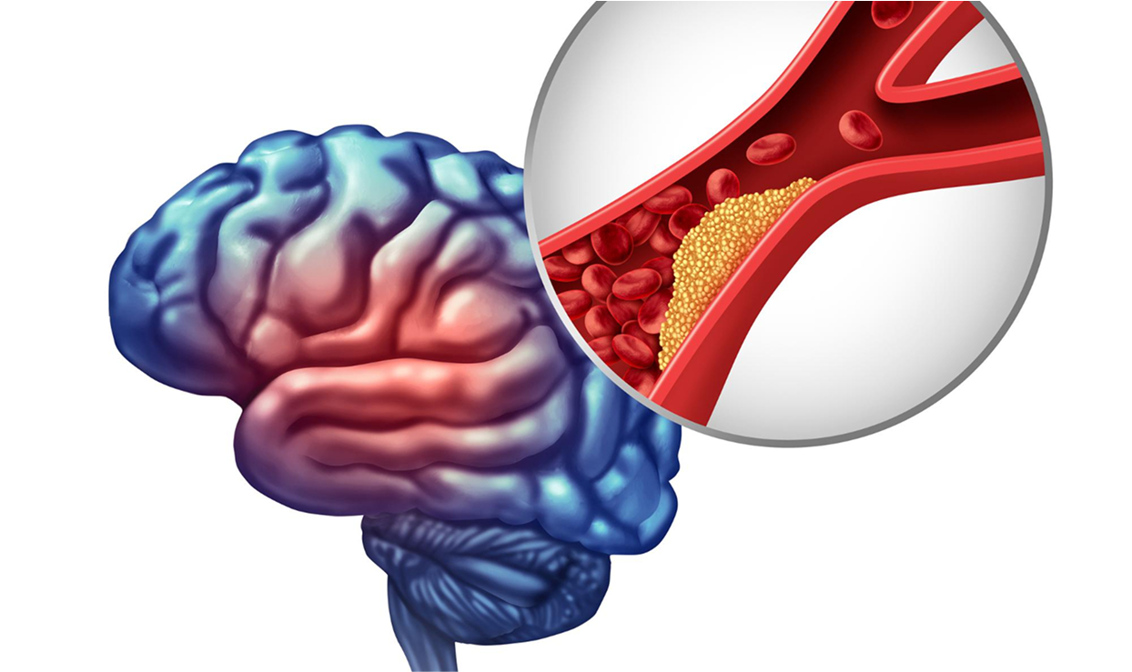 Illustration of a brain with a magnified clogged artery.