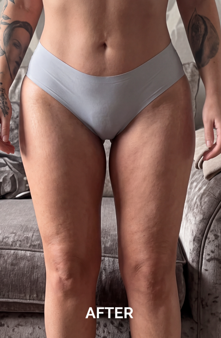 A close-up of a woman's lower torso and thighs in light blue underwear, labeled 'AFTER'.
