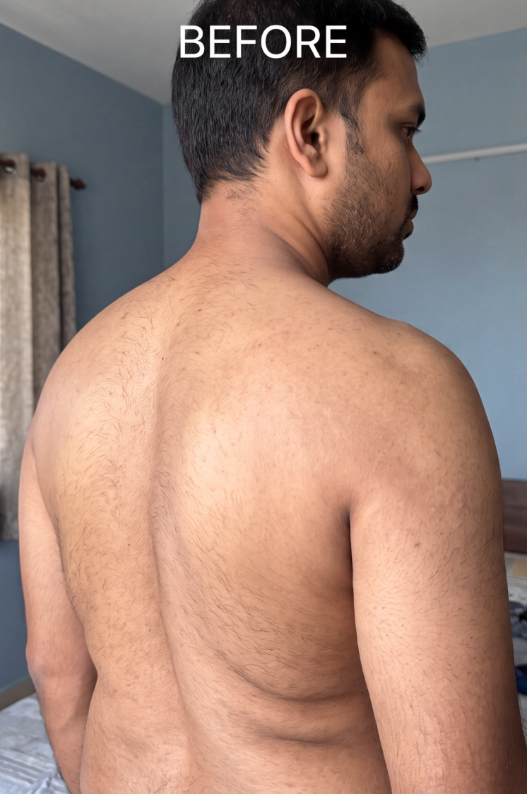 A three-quarter view of a shirtless man's back and head, with the word 'BEFORE' at the top.