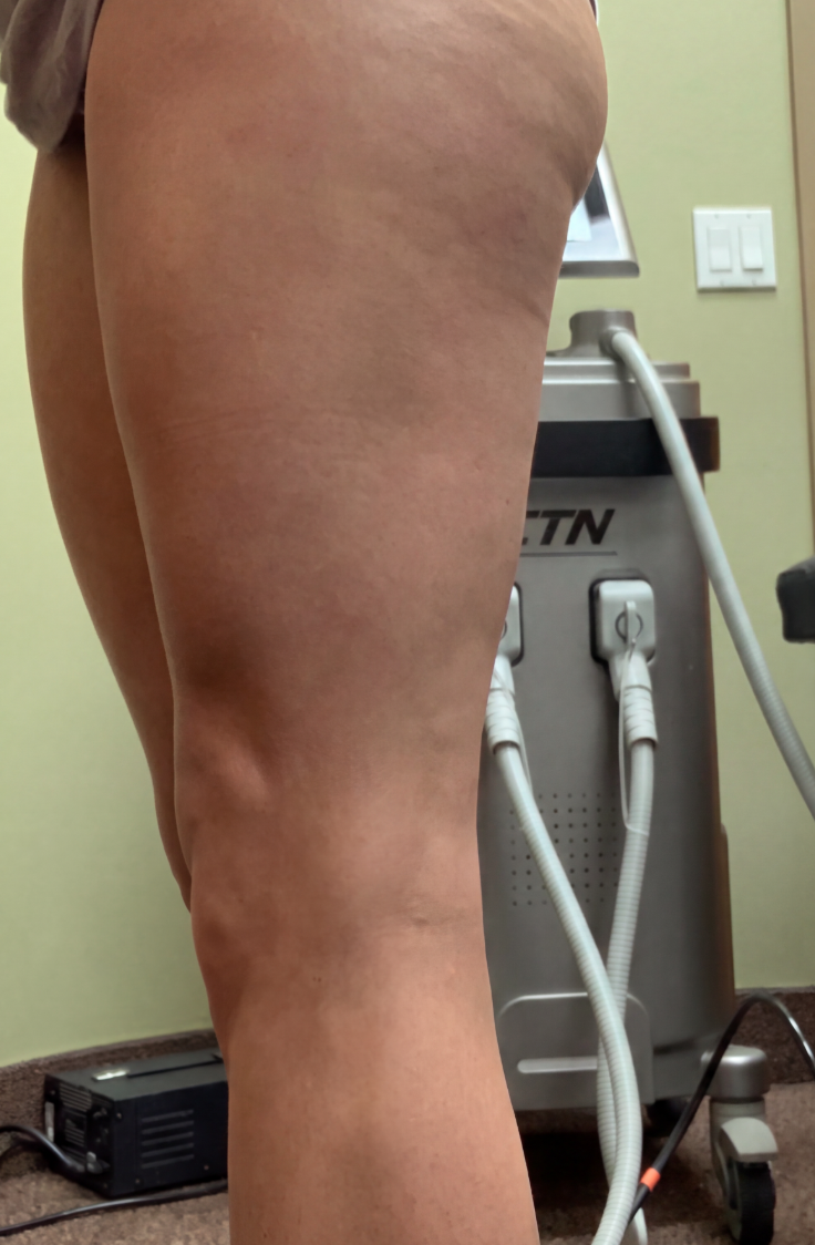 A close-up of the back of a person's thighs showing cellulite, next to a piece of equipment.
