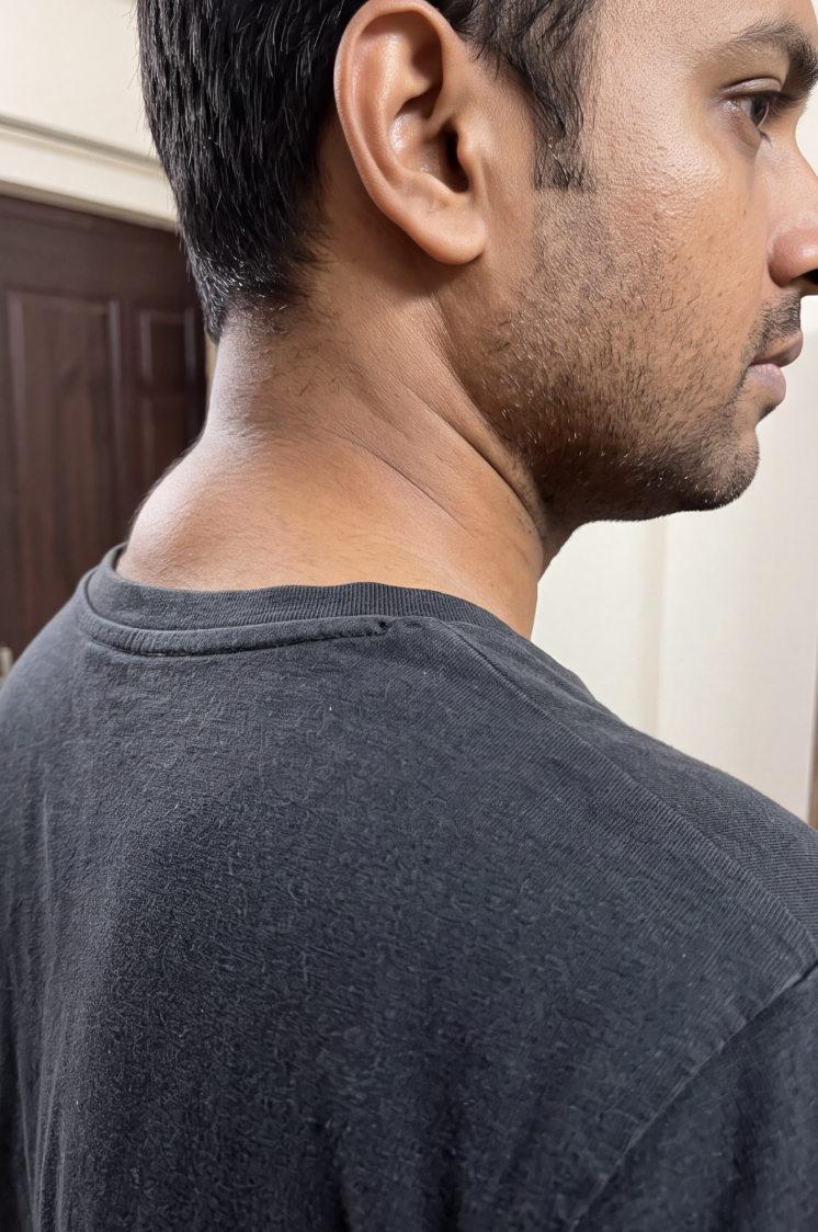 A close-up, side-profile view of a man's neck showing a large lump at the base.