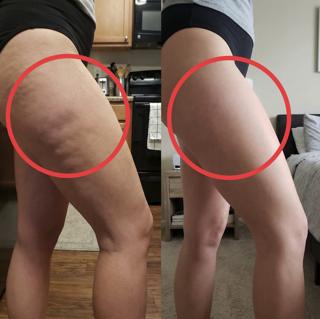 A before and after comparison of a woman's thigh, showing a reduction in the appearance of cellulite.