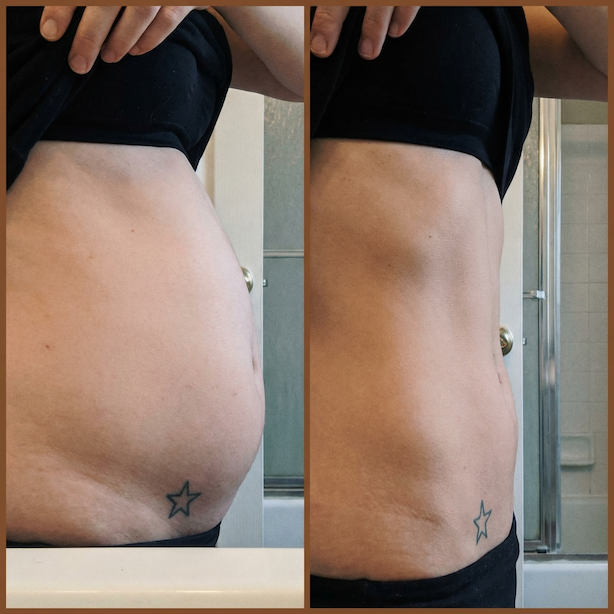 A side-by-side comparison of a person's abdomen, showing a change from distended to flatter.