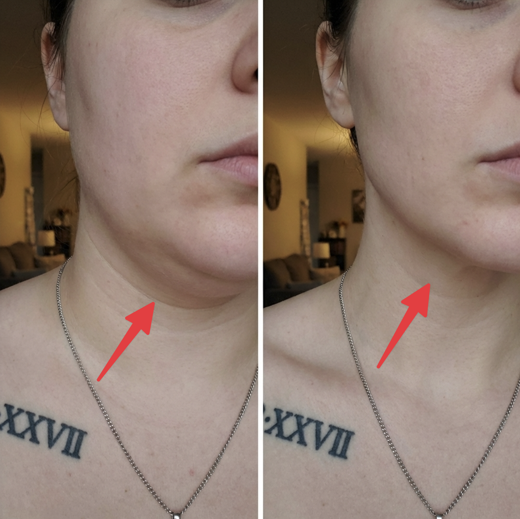 A before-and-after comparison of a woman's neck and jawline, with red arrows highlighting the difference.