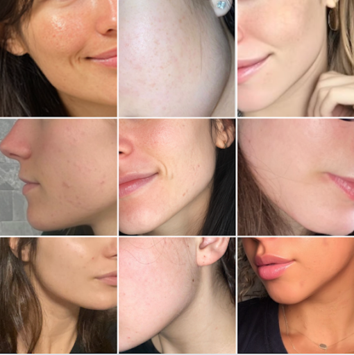 Collage of close-up images showing various people's cheeks and jawlines.