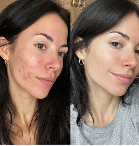 Side-by-side comparison of a woman's face before and after skin treatment.