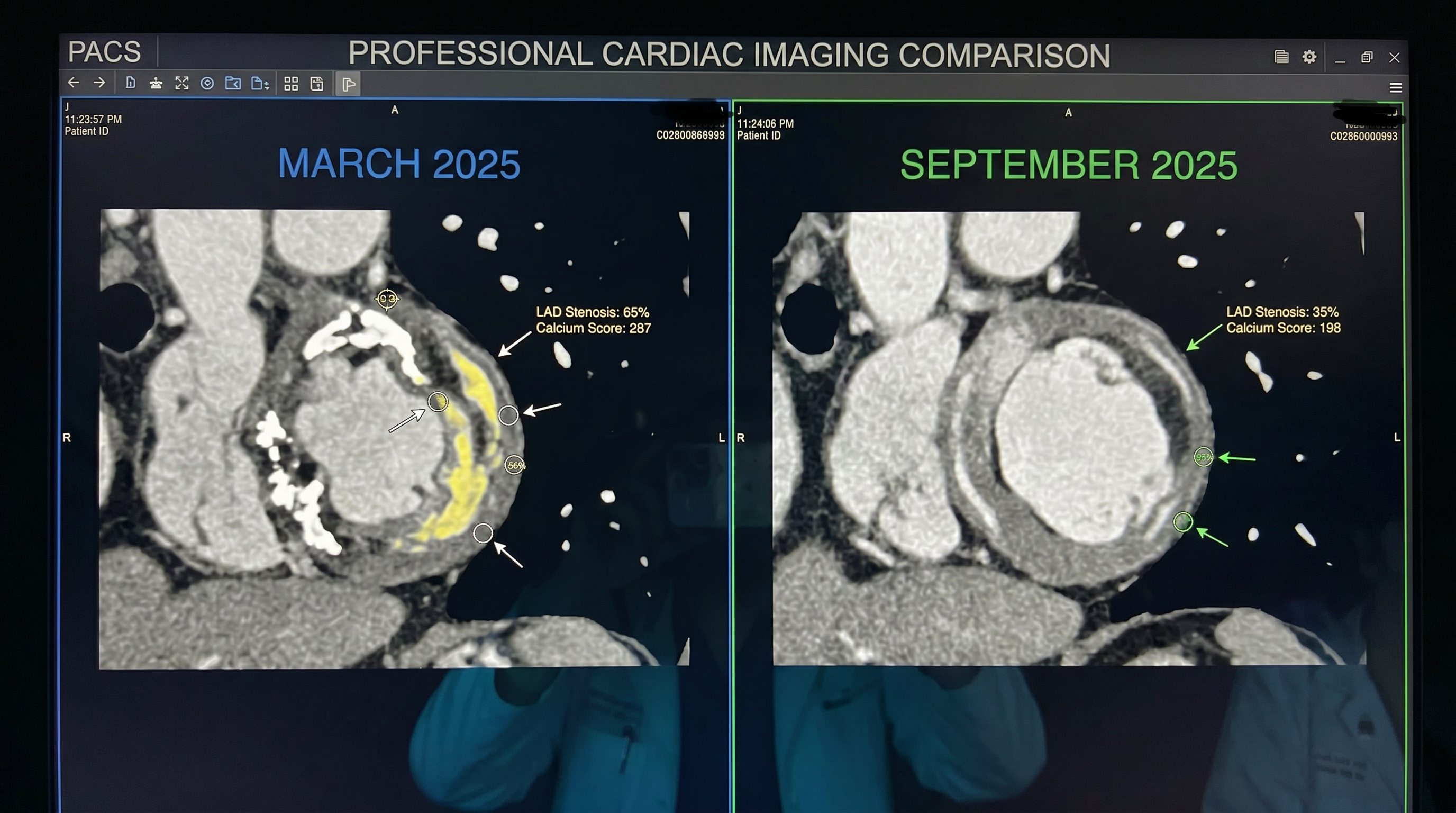 Dr. Marcus Reed's cardiac CT scan comparison showing reduced calcification