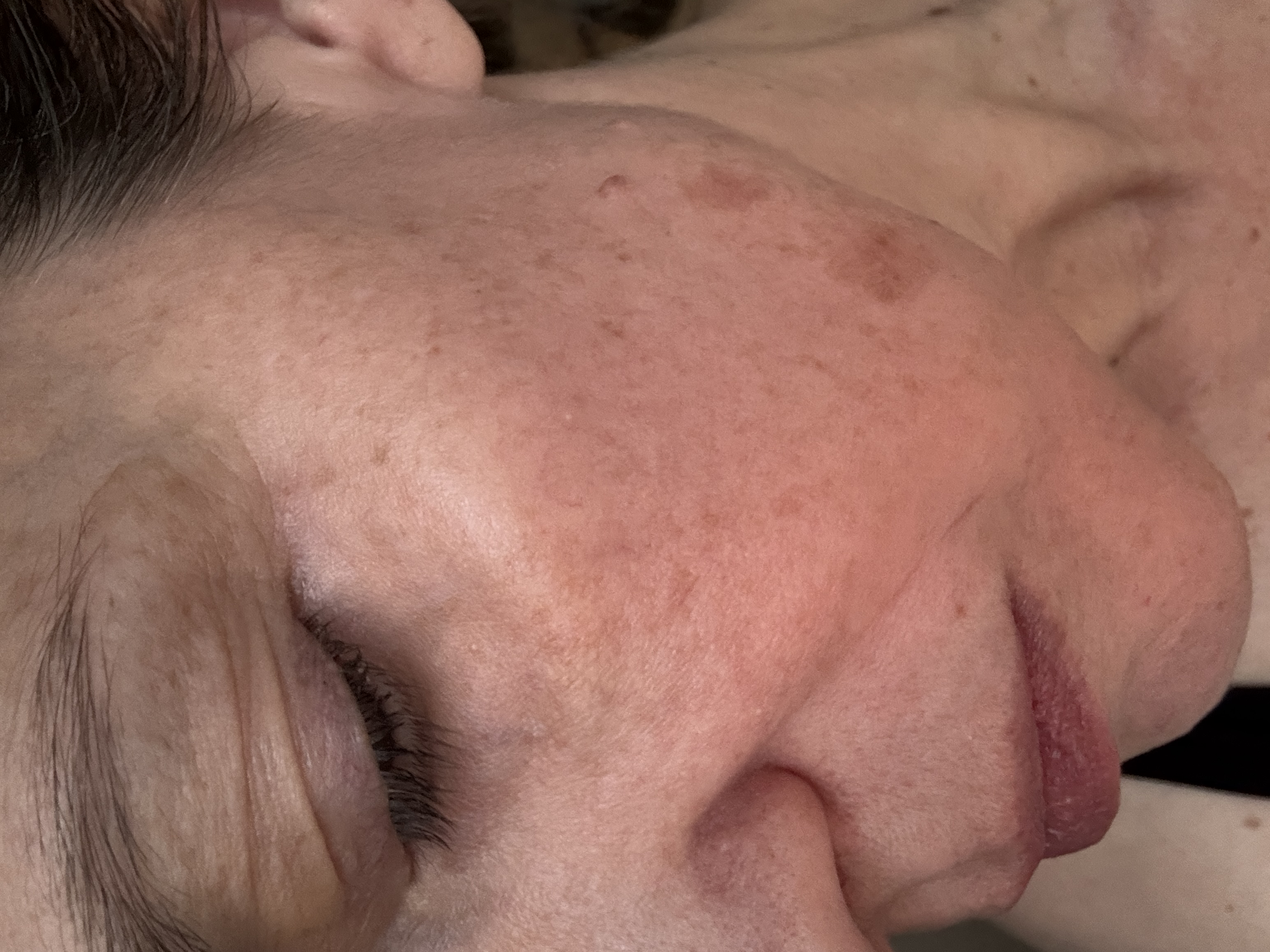 Close-up of a woman's face with visible skin texture and spots.