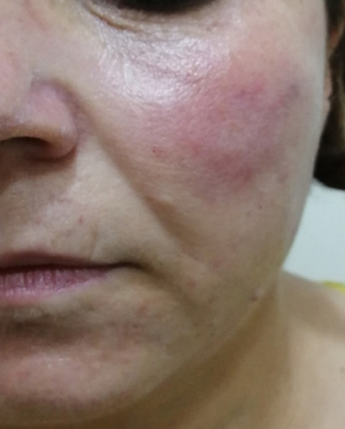 Close-up of a person's face with red irritated skin on the cheek.
