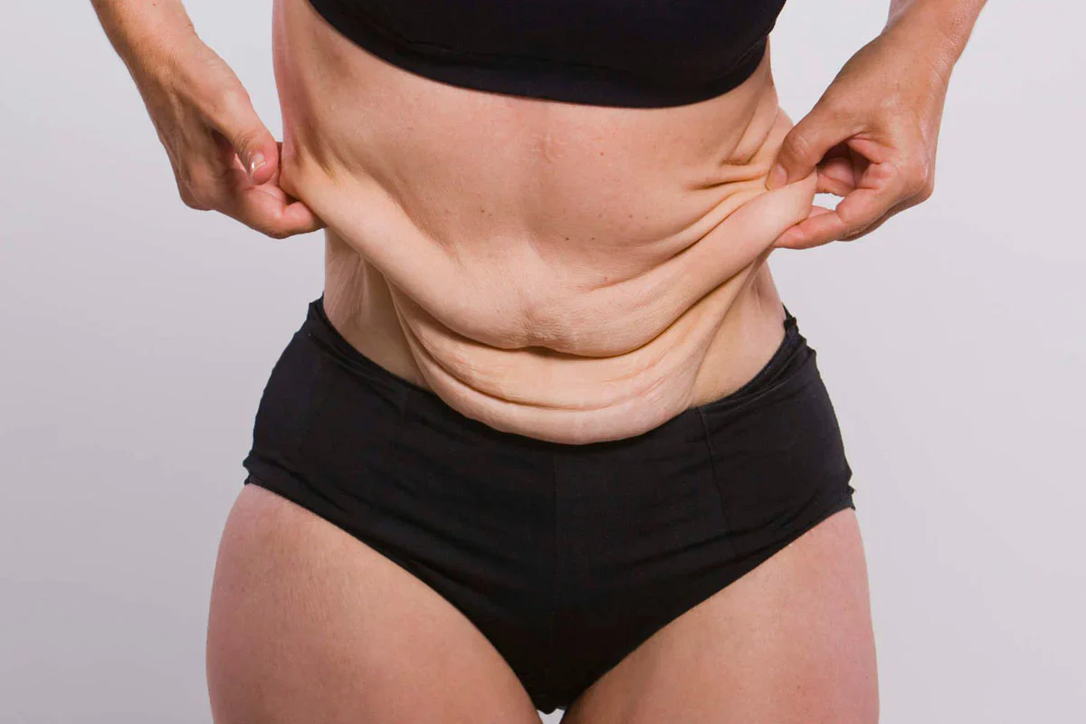 A woman in black underwear and bra pulls at the loose skin on her abdomen with both hands.