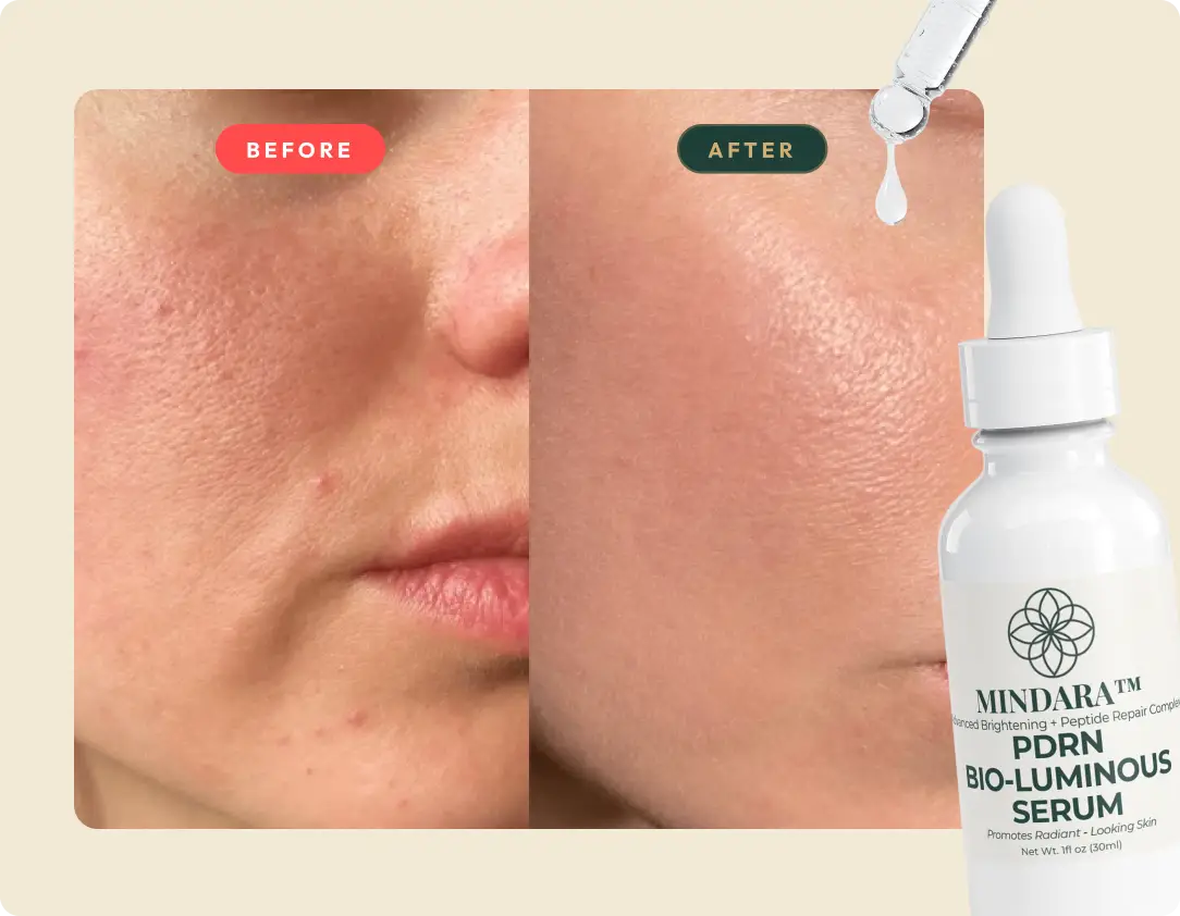 A before-and-after image showing improved skin texture, next to a bottle of Mindara PDRN Bio-Luminous Serum.