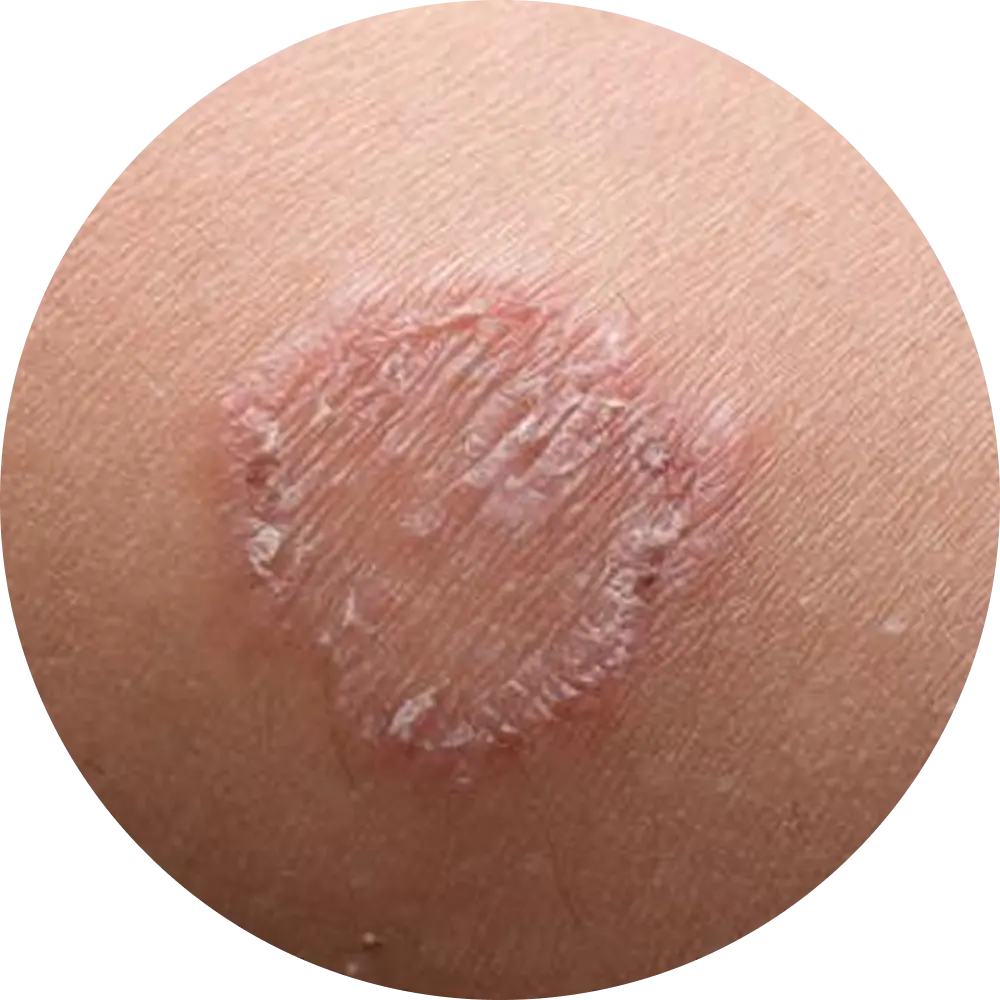 Close-up of a round, dry, and flaky patch on skin.