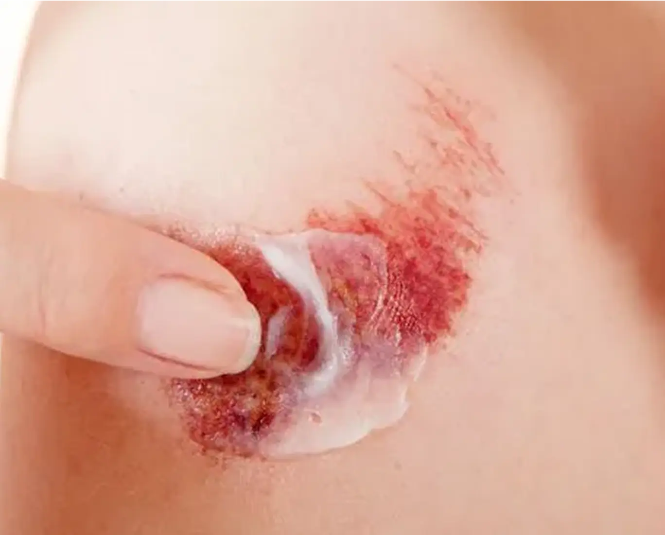 Finger applying cream to a red, irritated skin area.