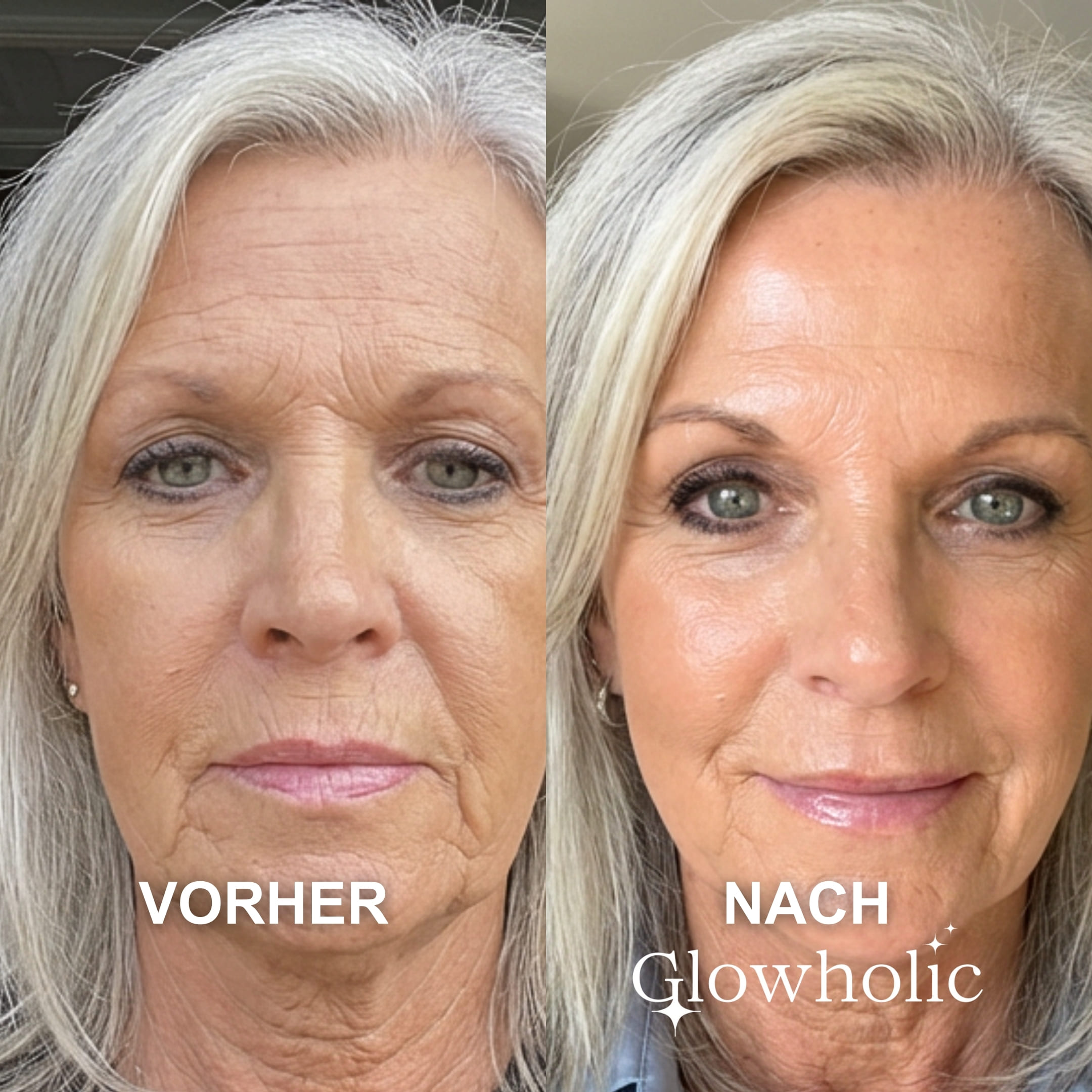 A before-and-after image of a woman's face, showing a visible reduction in wrinkles and smoother skin.