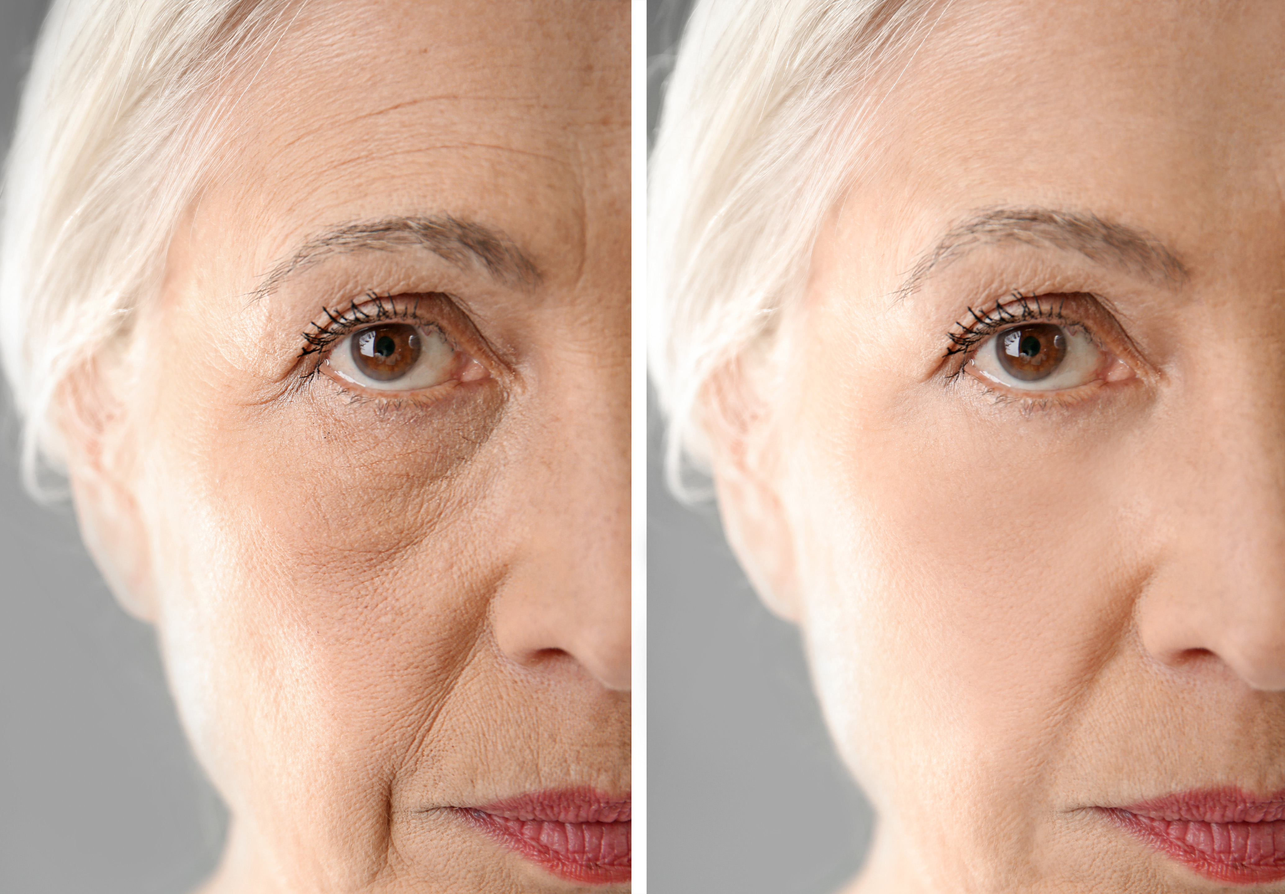Side-by-side comparison of an older woman's face before and after treatment.