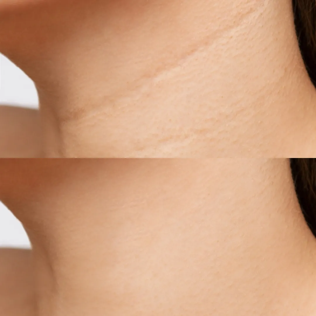 A before-and-after image showing the reduction of scars on a person's neck.