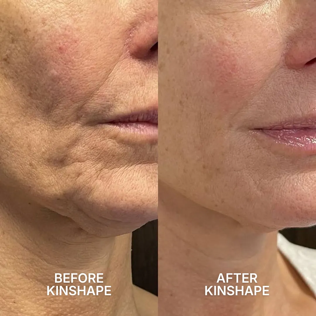 A before and after comparison of a woman's lower face and neck showing a reduction in wrinkles and sagging skin.