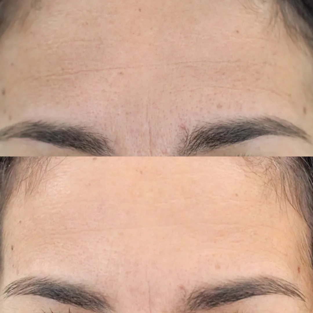 A before and after image showing a woman's forehead with a visible reduction in wrinkles.