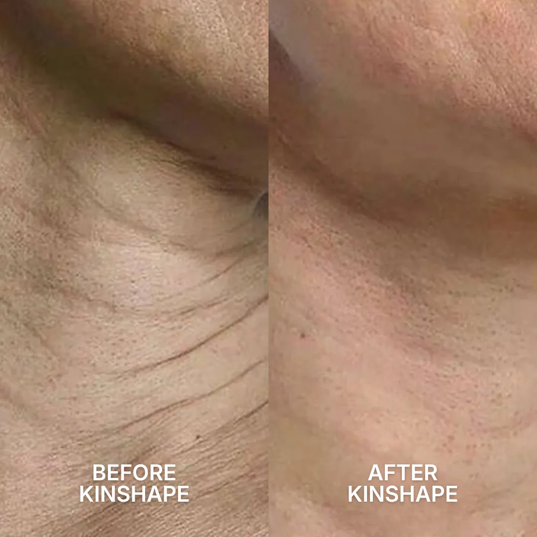 A before and after close-up of wrinkled neck skin, showing it looking smoother and firmer after treatment.