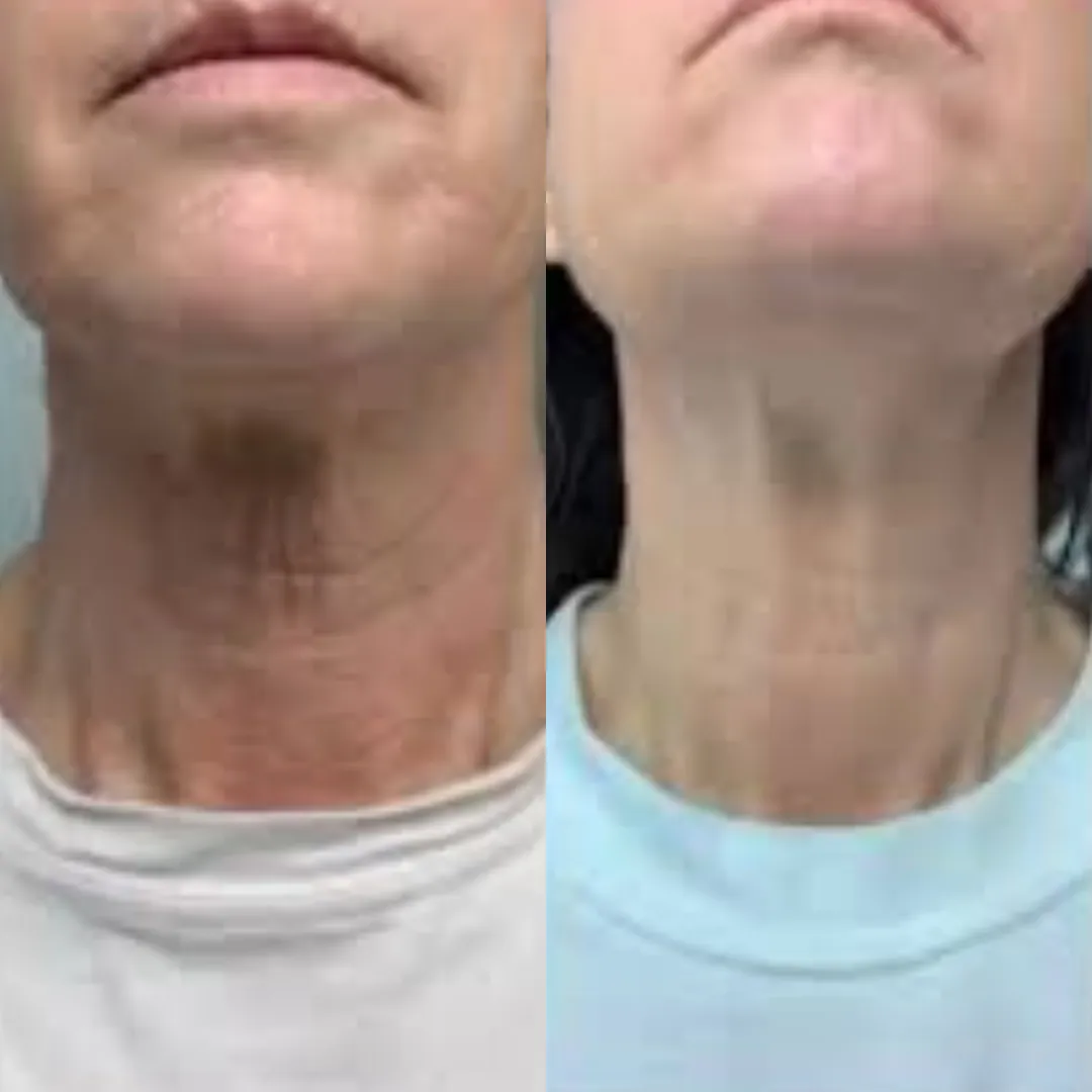 A before and after comparison of a woman's chin and neck, showing reduced discoloration and wrinkles.