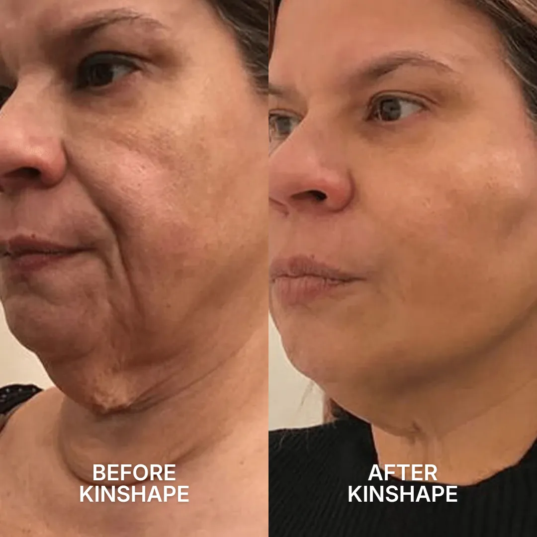 A before and after comparison of a woman's jawline, showing a reduction in wrinkles and sagging skin.