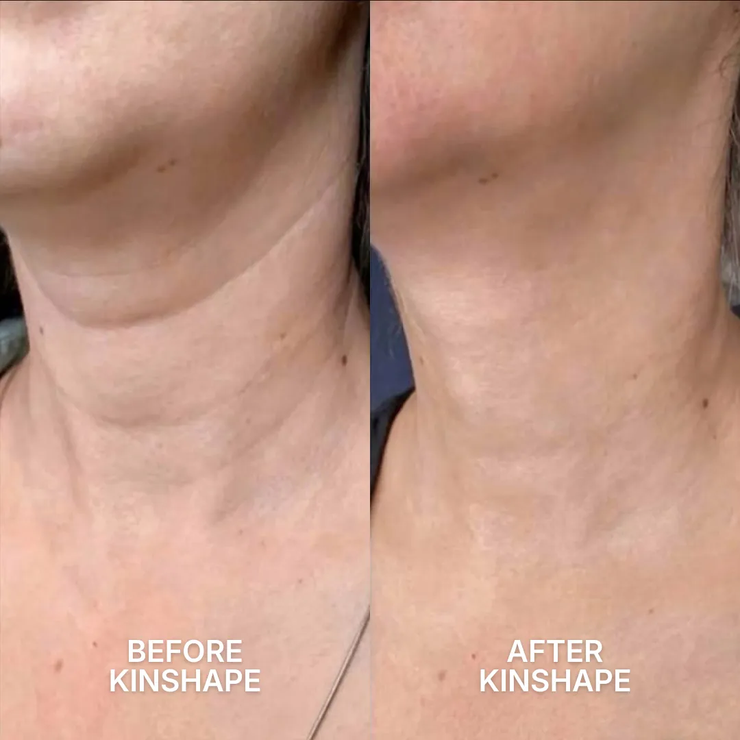 A before and after comparison of a person's neck, showing a reduction in sagging skin and wrinkles.