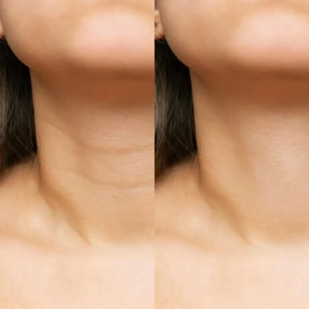 A before-and-after comparison of a person's neck, showing a reduction in the appearance of wrinkles.
