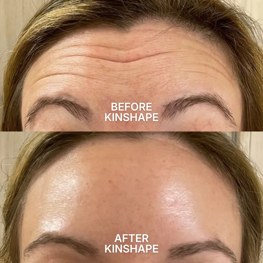 A before and after image showing a woman's forehead with deep wrinkles smoothed out.