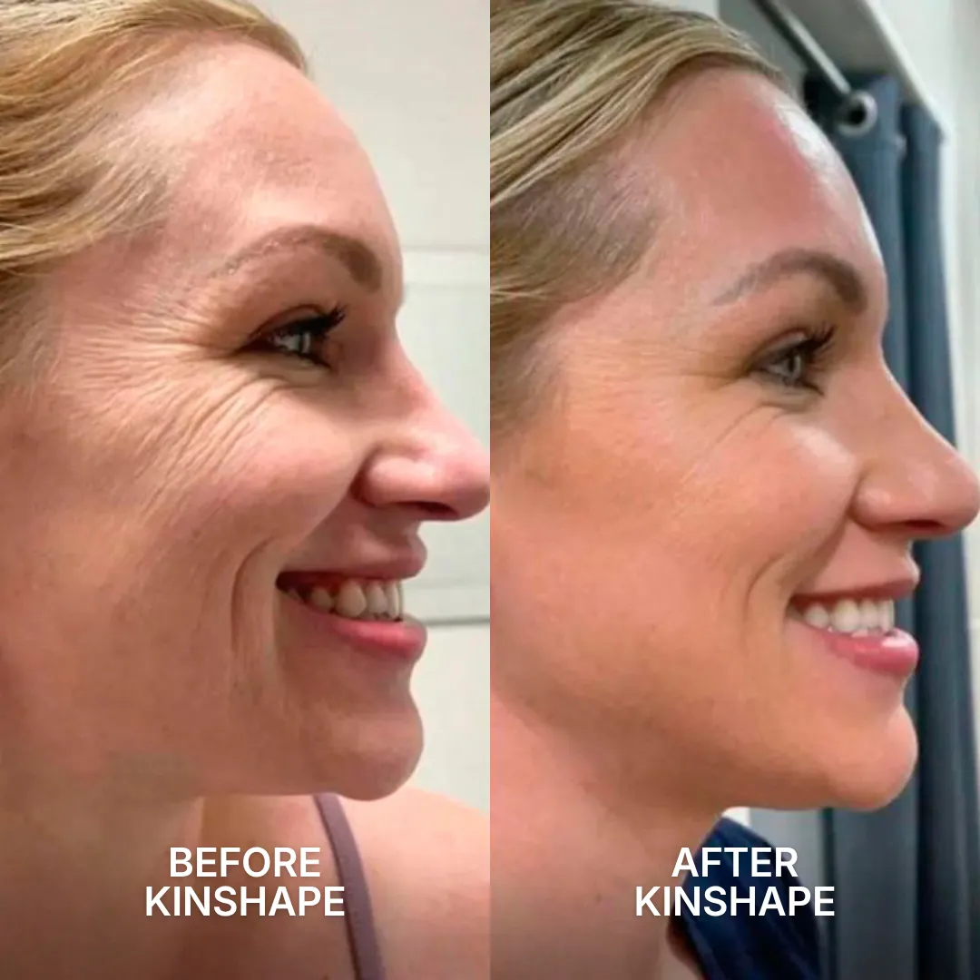 A before-and-after split image showing a reduction in a smiling woman's crow's feet wrinkles.