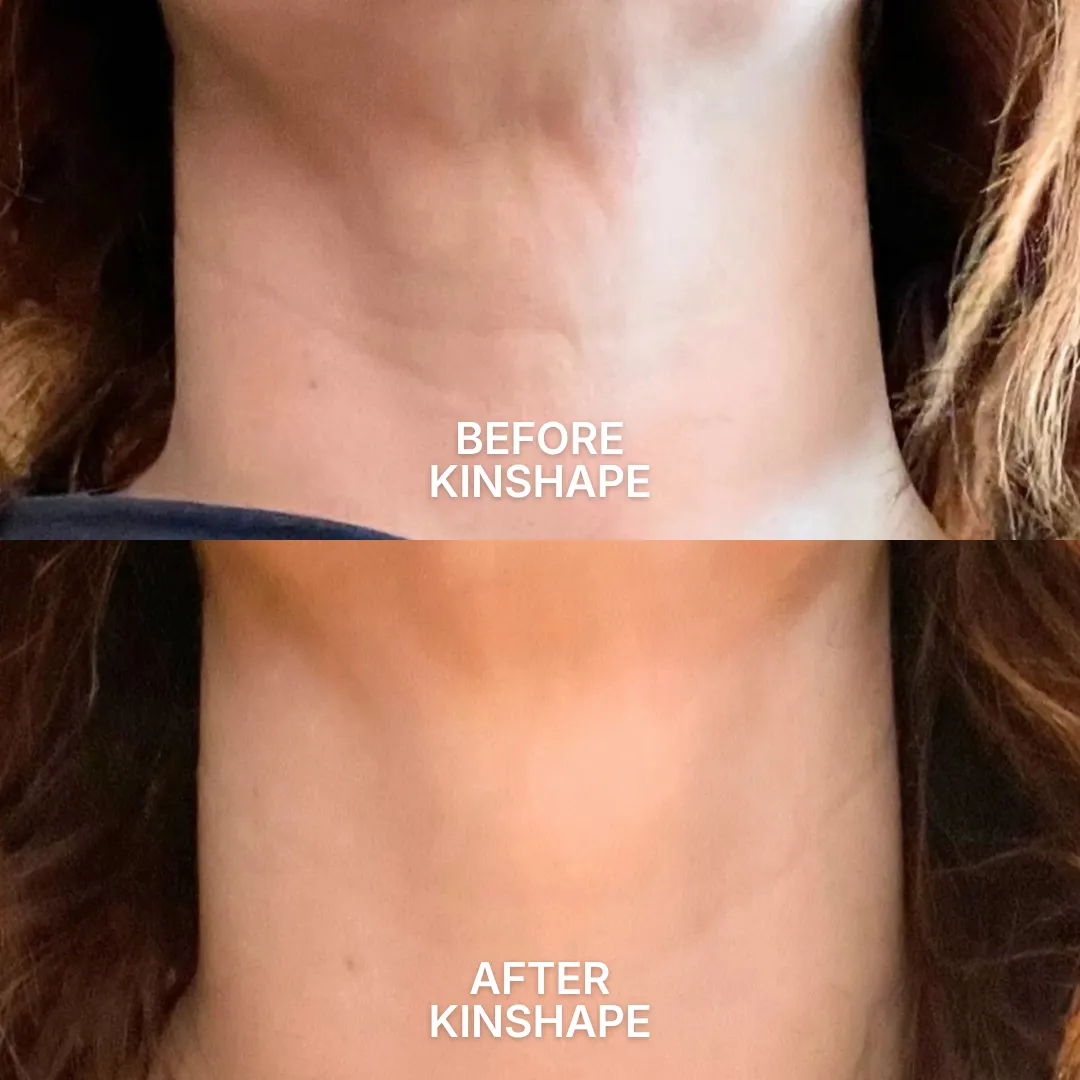 A before-and-after comparison of a person's neck, showing a reduction in lines and wrinkles.
