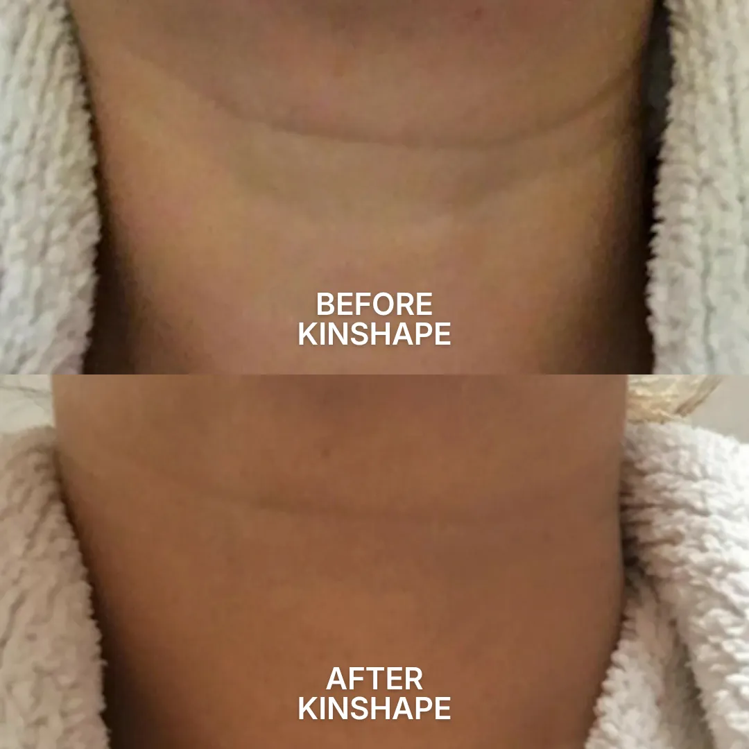A before and after comparison image of a person's neck, showing a reduction in the appearance of lines.
