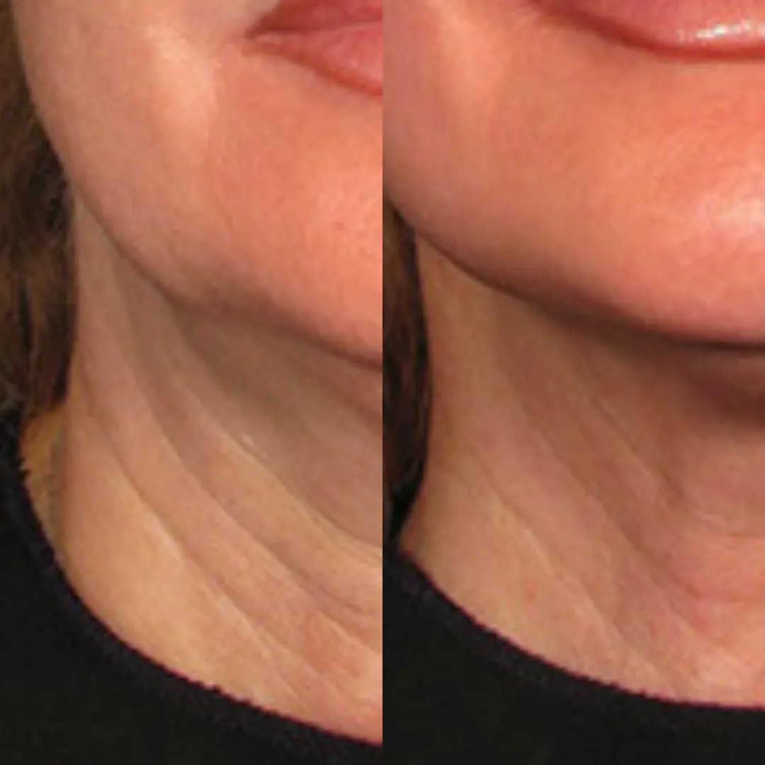 A before and after comparison showing the reduction of horizontal lines on a woman's neck.