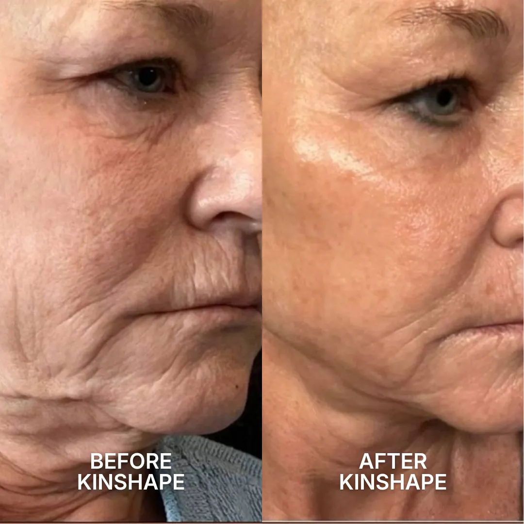 A before and after image of a woman's face showing a reduction in wrinkles and smoother skin.