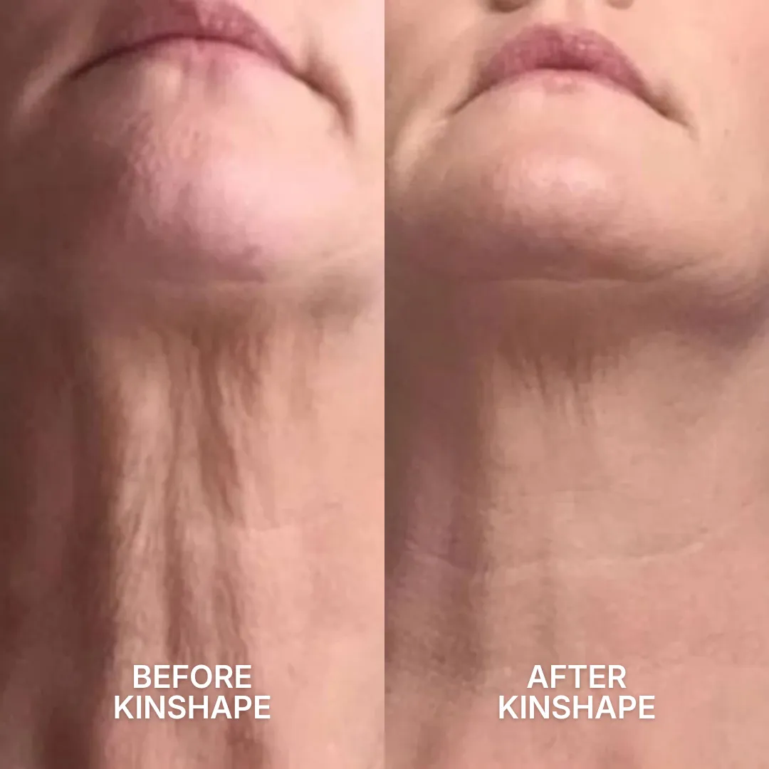 A before and after comparison of a person's neck, showing a reduction in wrinkles and sagging skin.