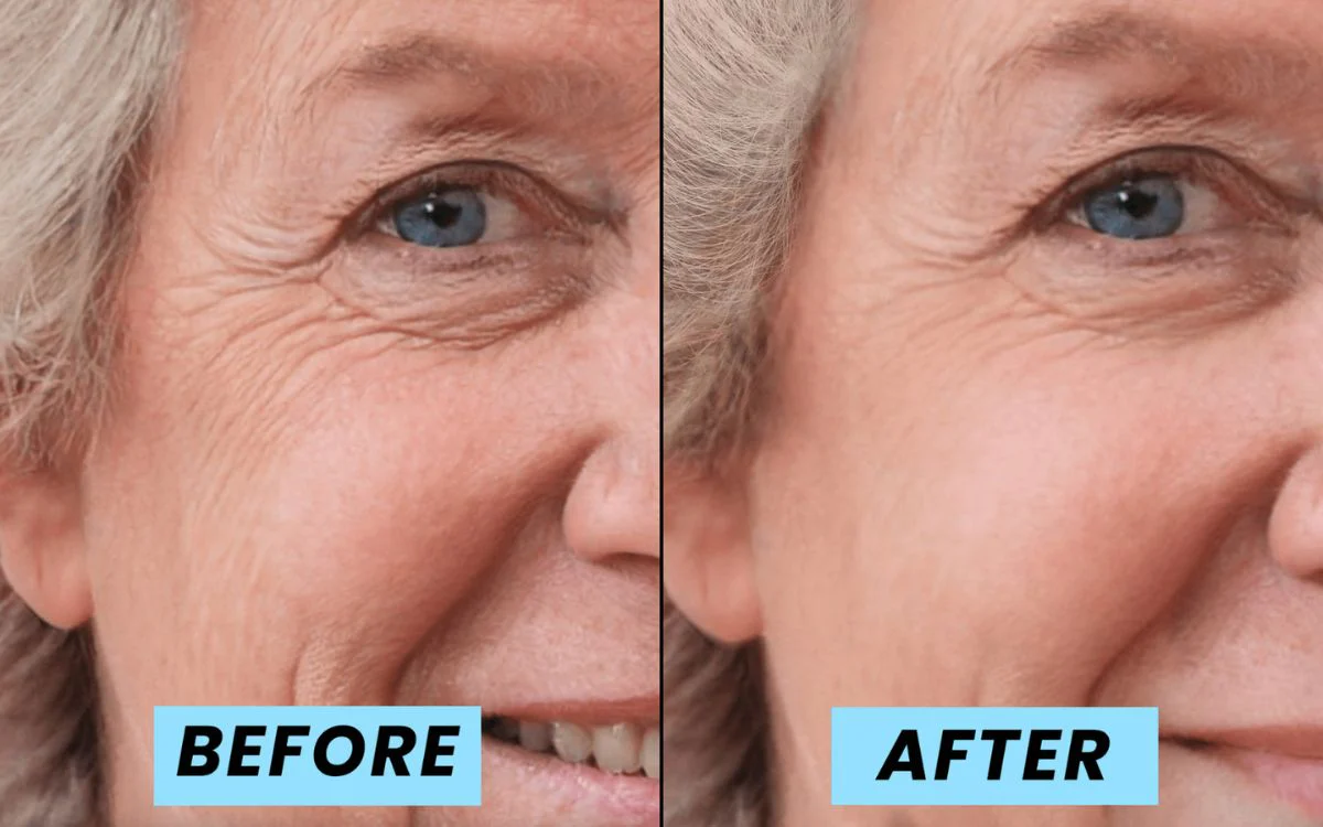 A before and after image shows a reduction of wrinkles on an older woman's face.