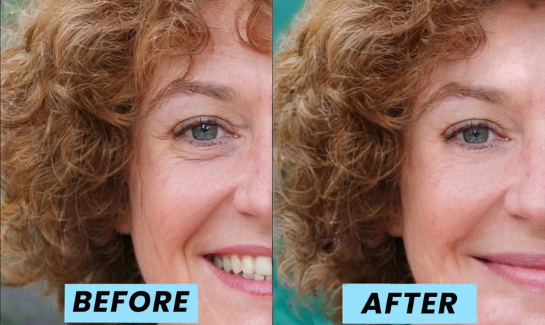 A before-and-after split image of a woman's face, showing a reduction in eye wrinkles.