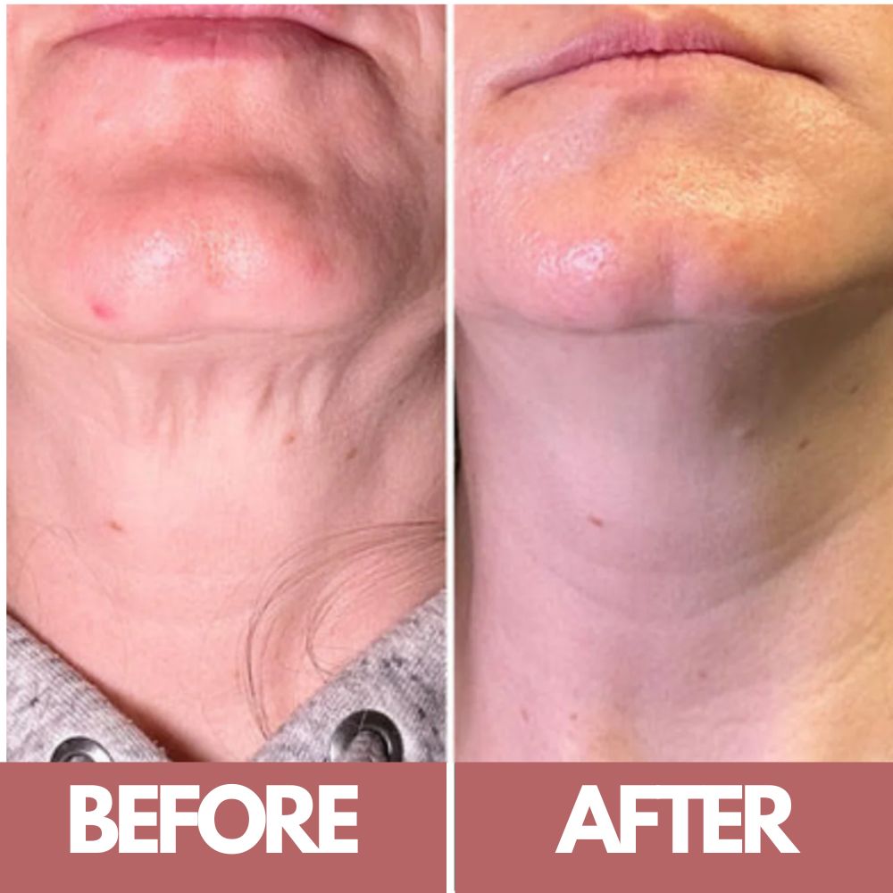 Side-by-side comparison of a neck before and after treatment.