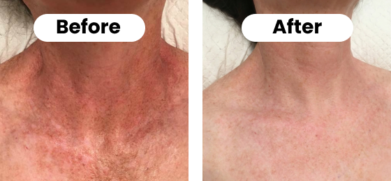 A before and after image of a person's neck, showing a reduction in skin redness and discoloration.