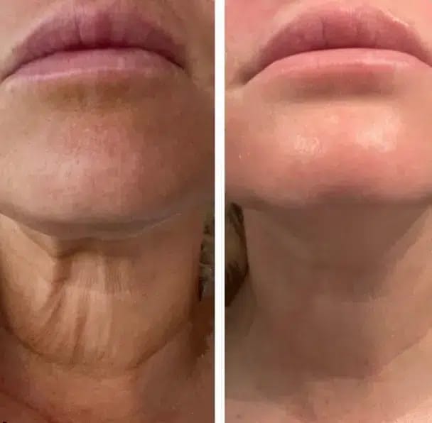 Side-by-side comparison of a neck before and after treatment.
