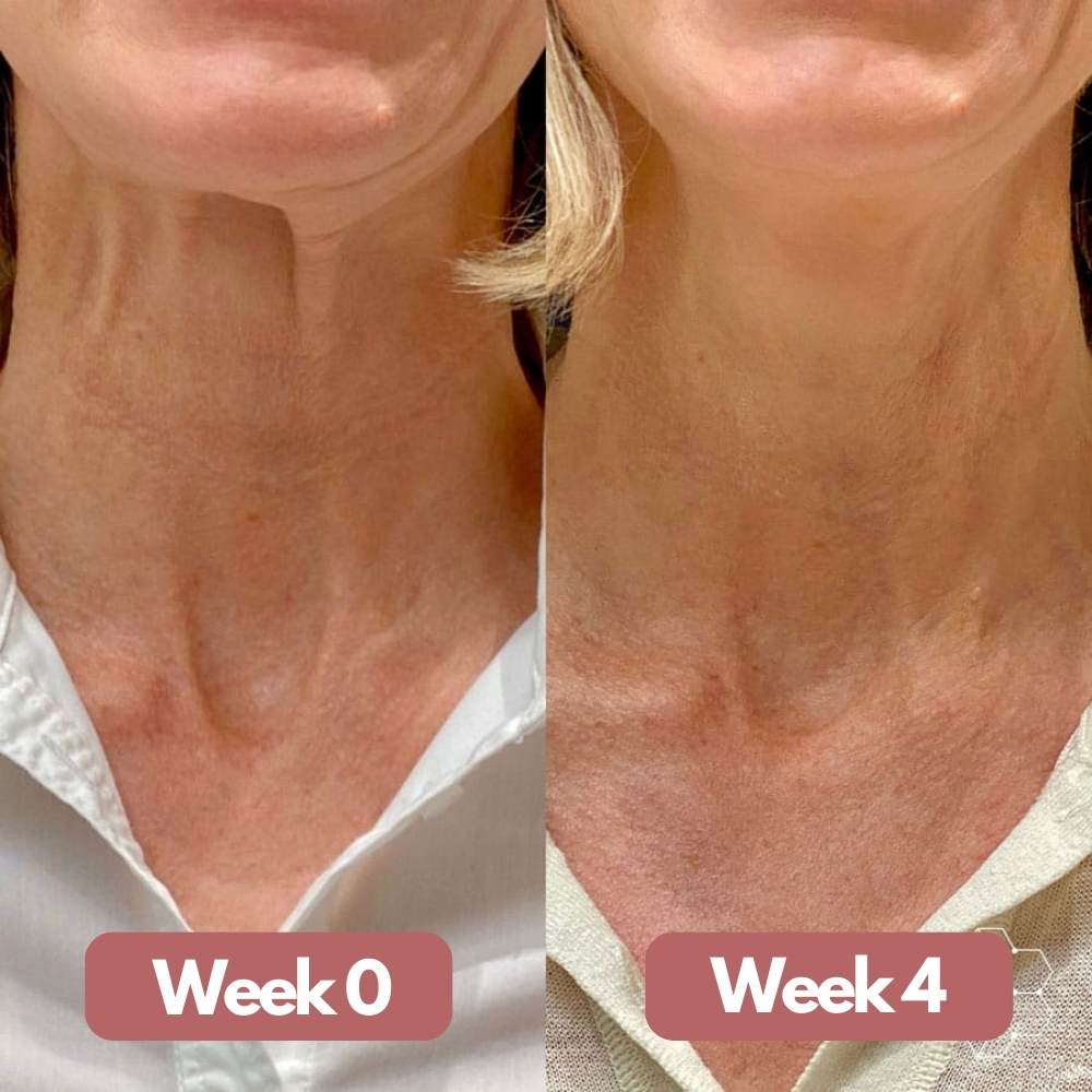 Side-by-side comparison of a neck at Week 0 and Week 4.