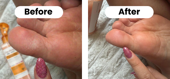 A before and after comparison of a foot sole, showing the skin going from dry to smooth.