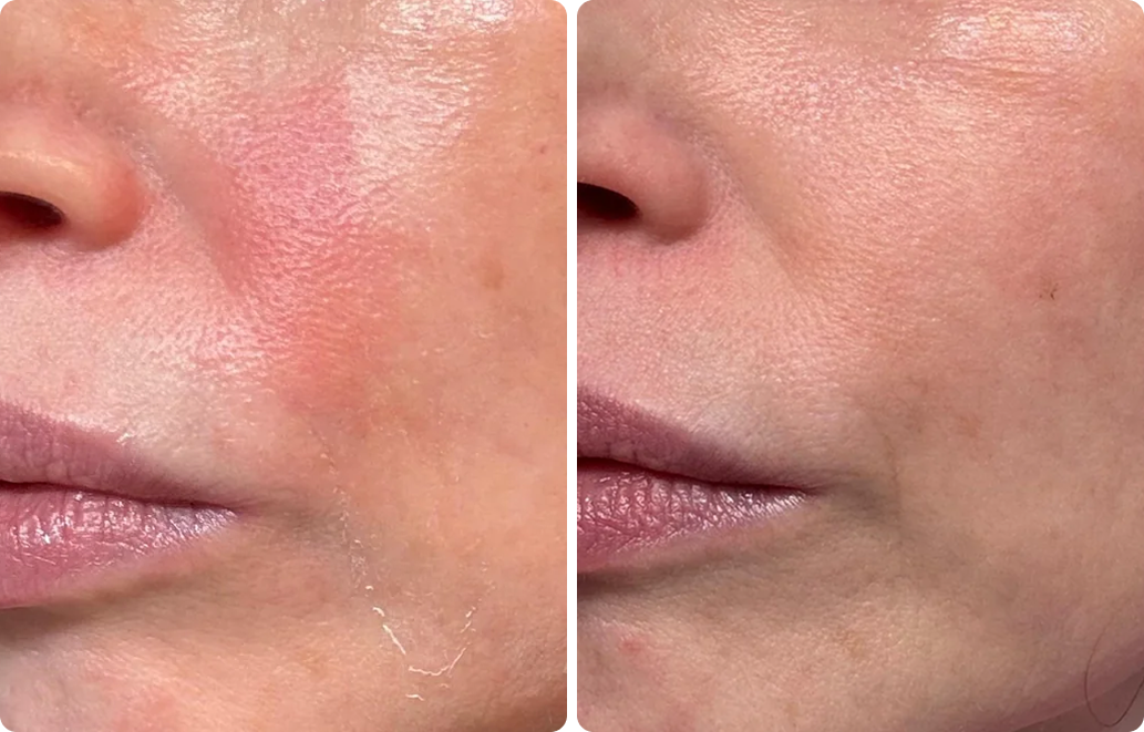 A before-and-after image showing a close-up of a person's cheek with reduced redness and peeling.