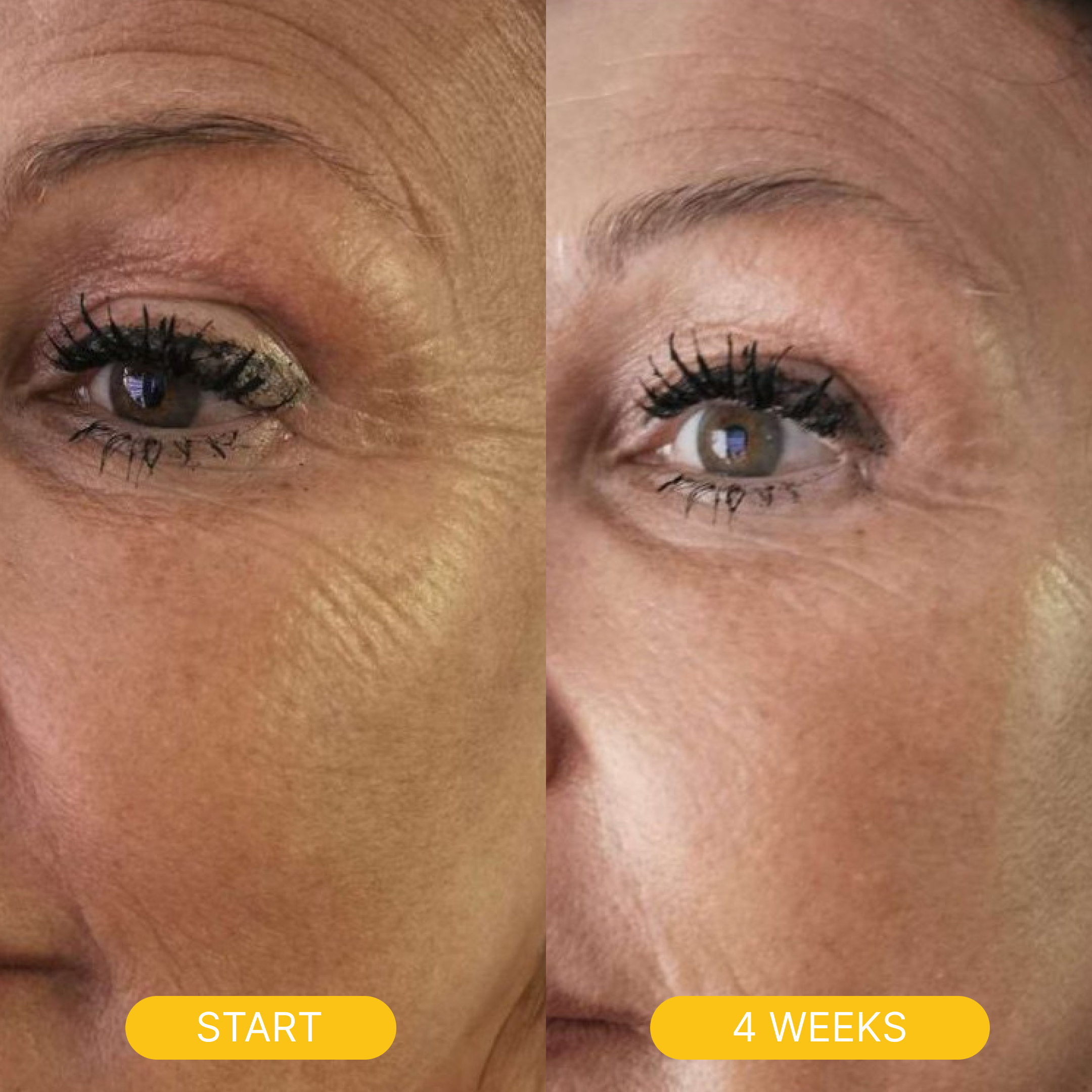 A before-and-after comparison showing a reduction of wrinkles around a woman's eye over four weeks.