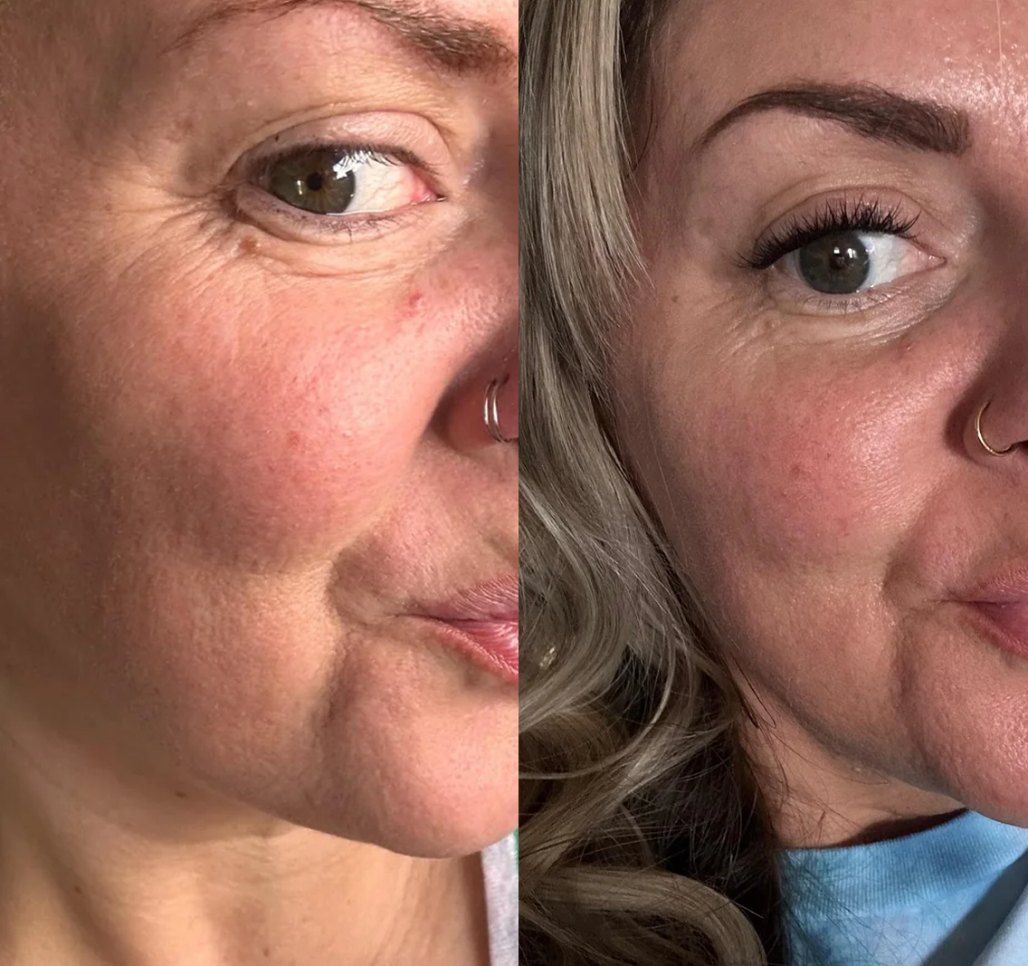 A before-and-after close-up of a woman's face, showing a reduction in wrinkles around the eye.