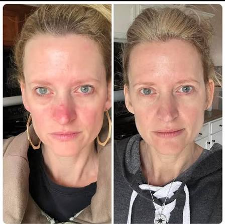A side-by-side comparison of a woman's face, showing a significant reduction in skin redness on the right.