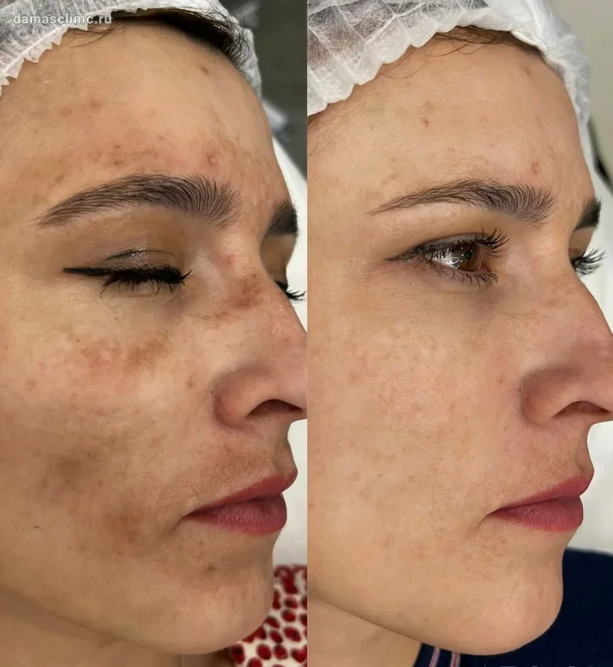 A side-by-side comparison of a woman's face, showing a reduction in dark spots and hyperpigmentation.