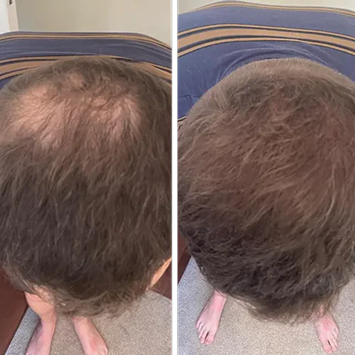 Two side-by-side images showing hair regrowth on a person's scalp from above.