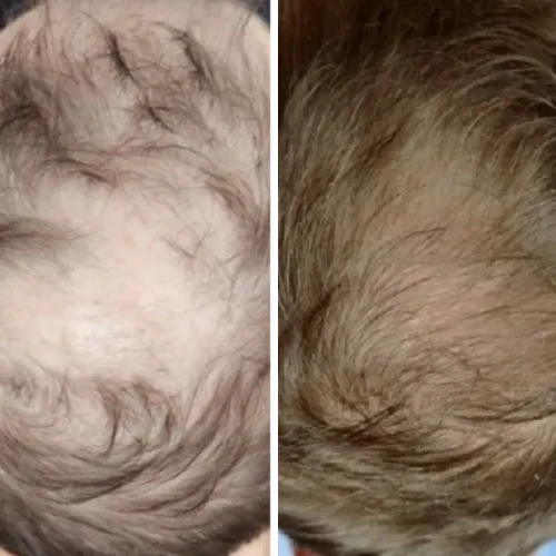 Side-by-side comparison of a scalp with less and more hair.
