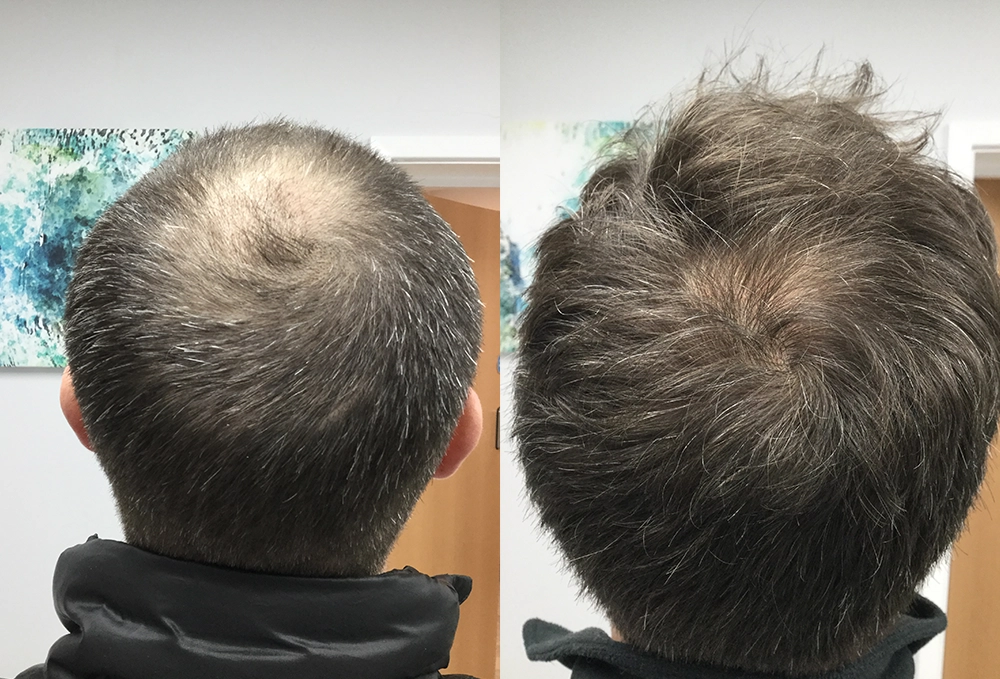 Two images showing the back of a person's head with different hair thickness.